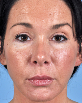 Face Lift Before and After | Dr. Thomas Hubbard