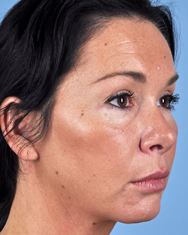 Face Lift Before and After | Dr. Thomas Hubbard