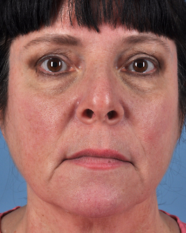 Face Lift Before and After | Dr. Thomas Hubbard