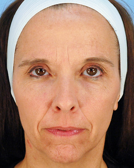 Face Lift Before and After | Dr. Thomas Hubbard