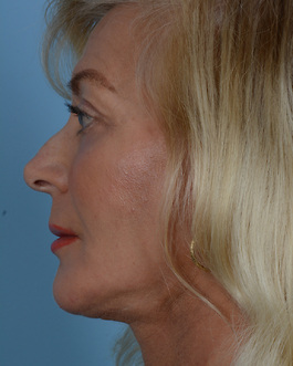 Face Lift Before and After | Dr. Thomas Hubbard