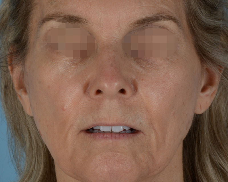 Face Lift Before and After | Dr. Thomas Hubbard