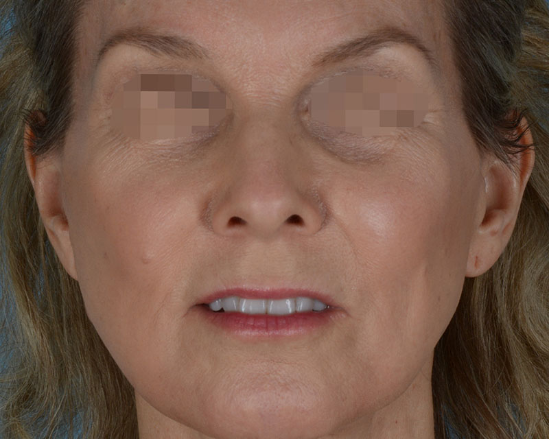 Face Lift Before and After | Dr. Thomas Hubbard