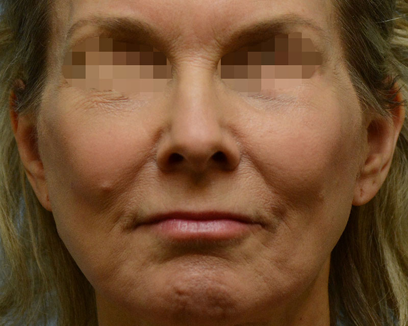 Face Lift Before and After | Dr. Thomas Hubbard