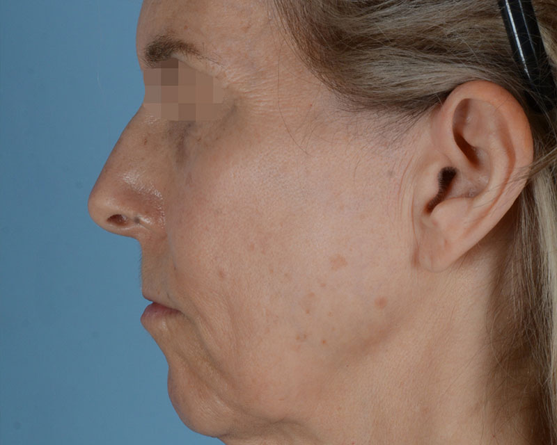 Face Lift Before and After | Dr. Thomas Hubbard