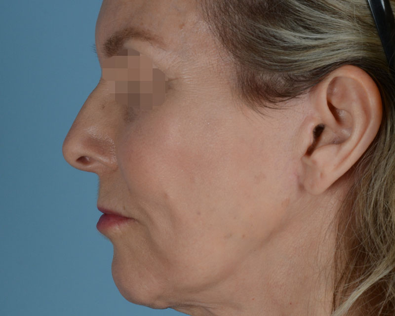 Face Lift Before and After | Dr. Thomas Hubbard