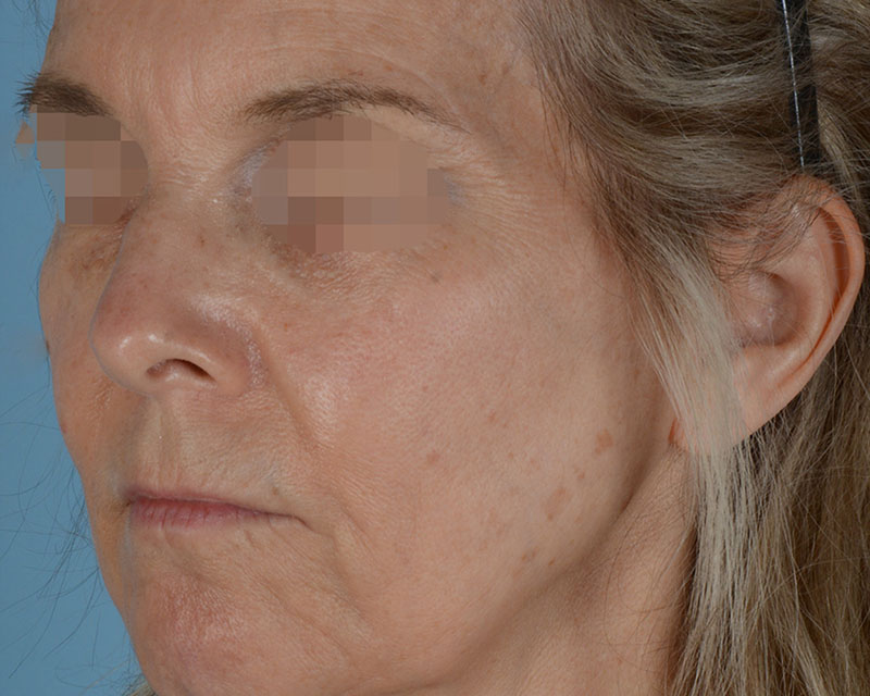 Face Lift Before and After | Dr. Thomas Hubbard