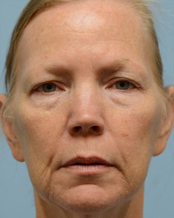 Face Lift Before and After | Dr. Thomas Hubbard