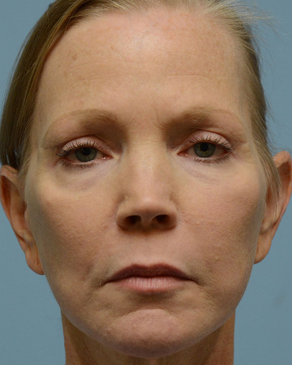 Face Lift Before and After | Dr. Thomas Hubbard