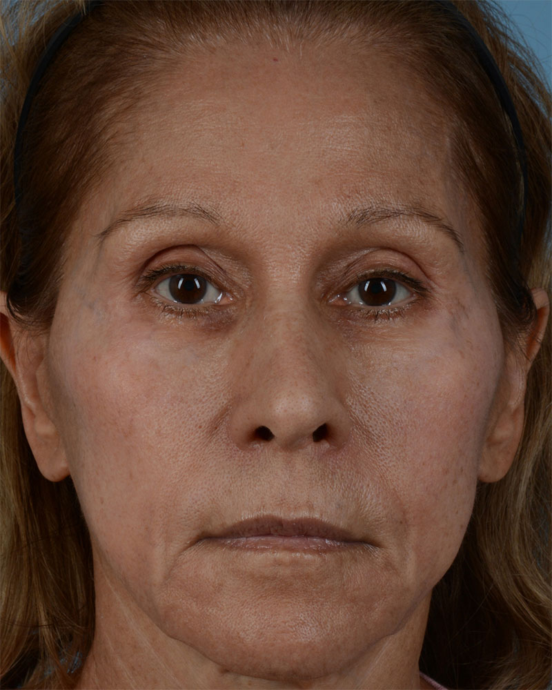 Face Lift Before and After | Dr. Thomas Hubbard