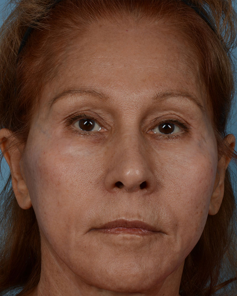 Face Lift Before and After | Dr. Thomas Hubbard