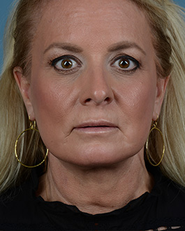 Face Lift Before and After | Dr. Thomas Hubbard