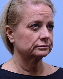 Face Lift Before and After | Dr. Thomas Hubbard