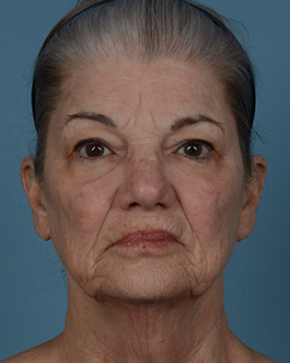 Face Lift Before and After | Dr. Thomas Hubbard