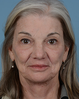 Face Lift Before and After | Dr. Thomas Hubbard