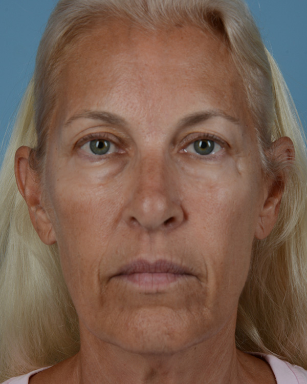 Face Lift Before and After | Dr. Thomas Hubbard
