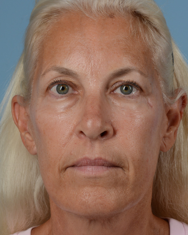 Face Lift Before and After | Dr. Thomas Hubbard