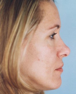 Facial Implants Before and After | Dr. Thomas Hubbard