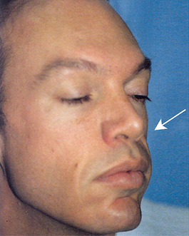 Facial Implants Before and After | Dr. Thomas Hubbard