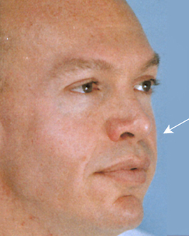 Facial Implants Before and After | Dr. Thomas Hubbard