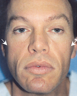 Facial Implants Before and After | Dr. Thomas Hubbard