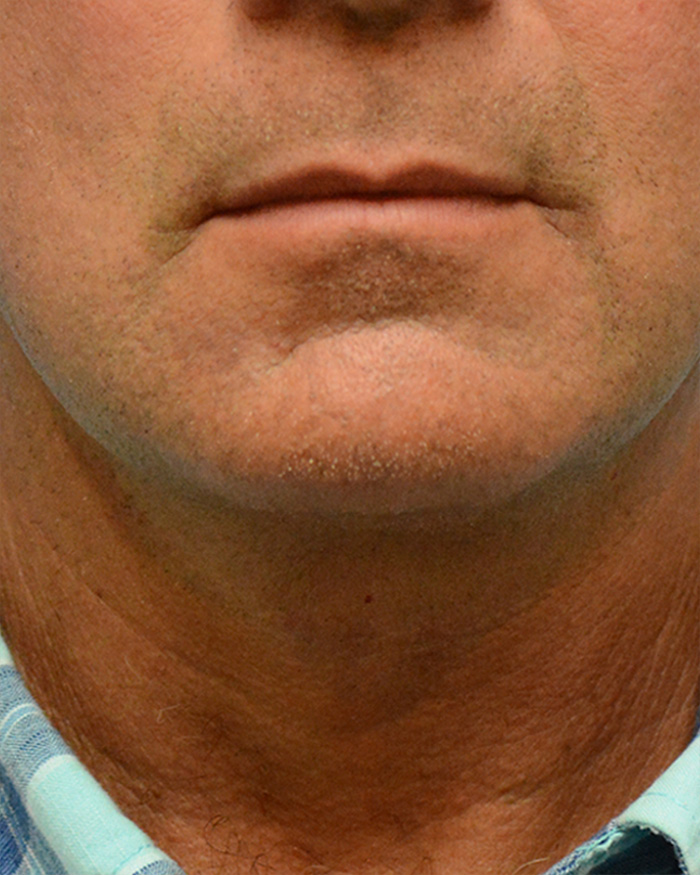 Facial Implants Before and After | Dr. Thomas Hubbard