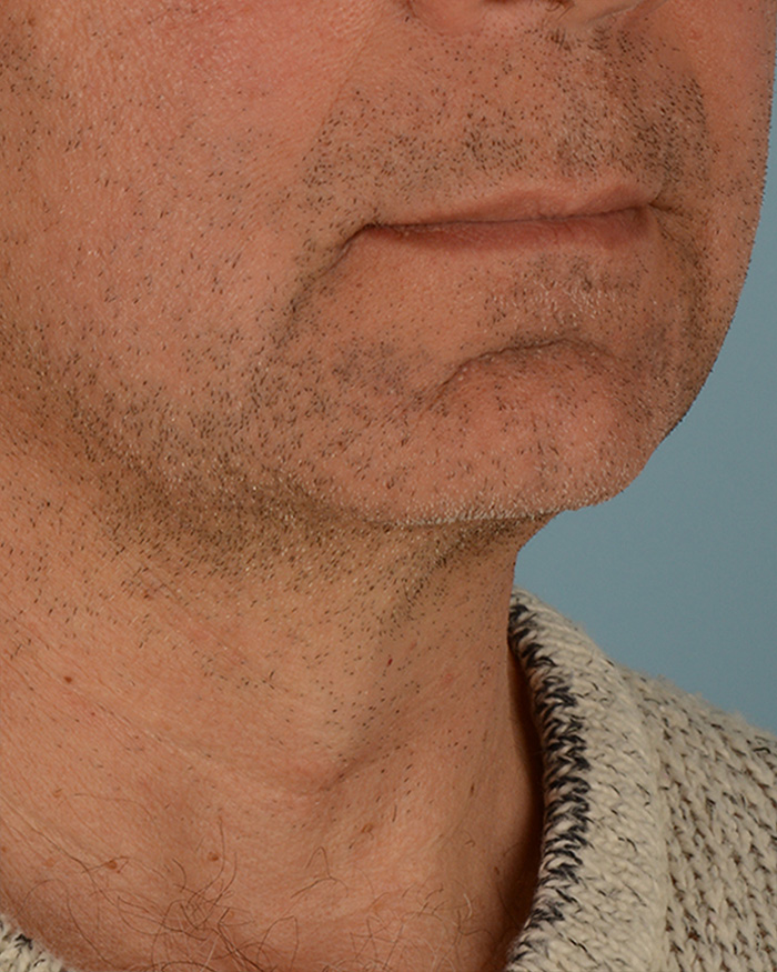 Facial Implants Before and After | Dr. Thomas Hubbard