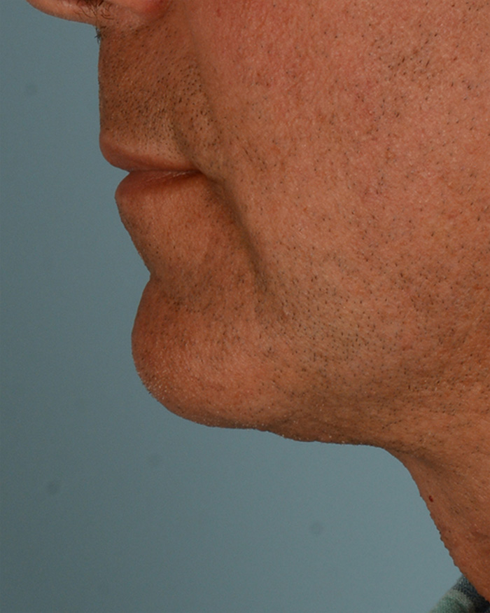 Facial Implants Before and After | Dr. Thomas Hubbard