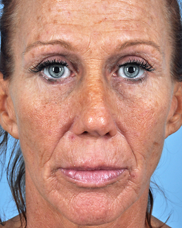 Laser Skin Resurfacing Before and After | Dr. Thomas Hubbard