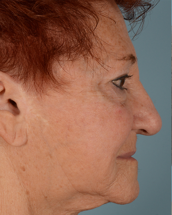 Laser Skin Resurfacing Before and After | Dr. Thomas Hubbard