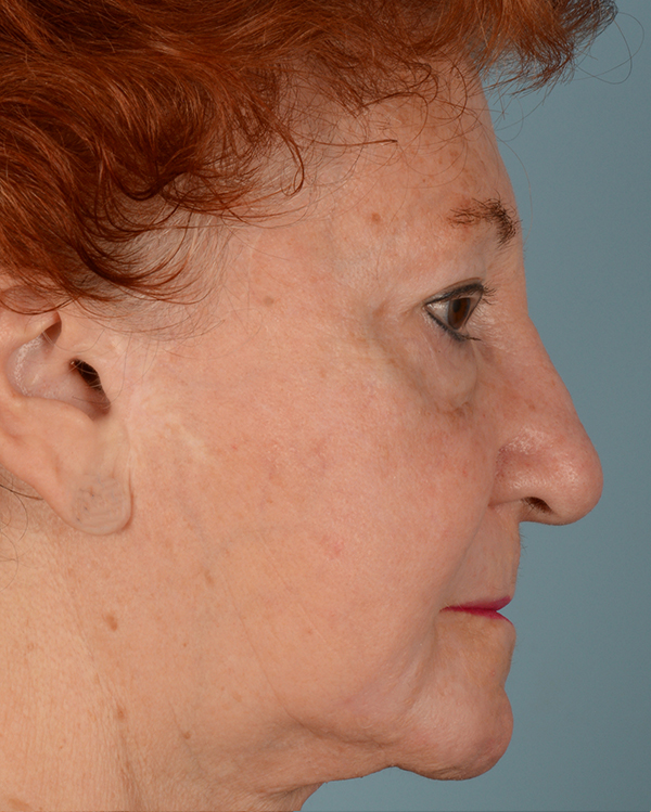 Laser Skin Resurfacing Before and After | Dr. Thomas Hubbard