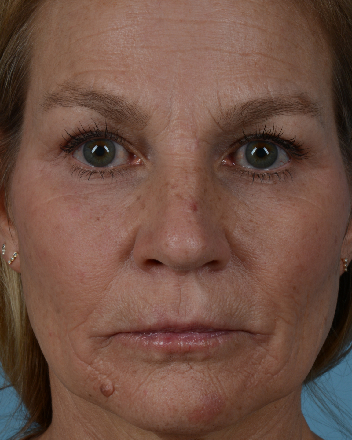 Laser Skin Resurfacing Before and After | Dr. Thomas Hubbard