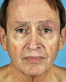 Male Face Procedures Before and After | Dr. Thomas Hubbard