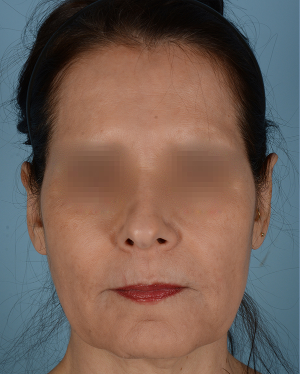 Otoplasty Before and After | Dr. Thomas Hubbard