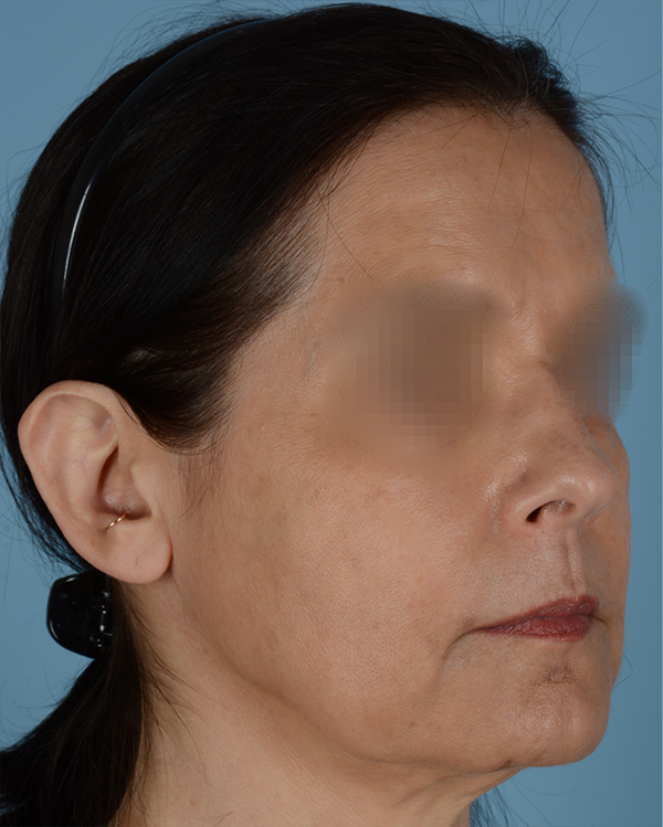 Otoplasty Before and After | Dr. Thomas Hubbard