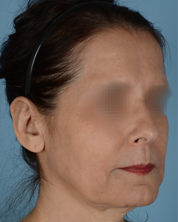 Otoplasty Before and After | Dr. Thomas Hubbard