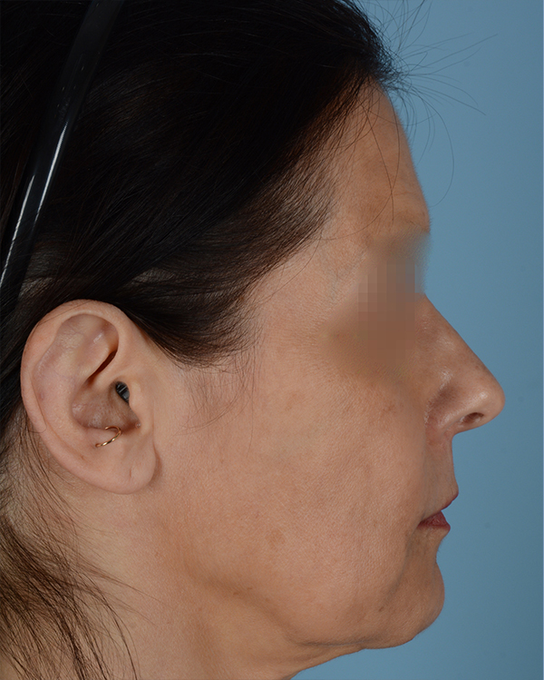 Otoplasty Before and After | Dr. Thomas Hubbard