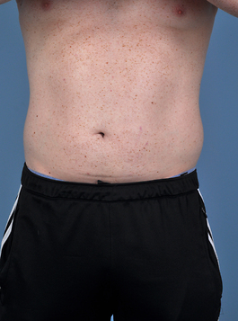 Coolsculpting Before and After | Dr. Thomas Hubbard