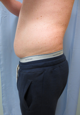 Coolsculpting Before and After | Dr. Thomas Hubbard