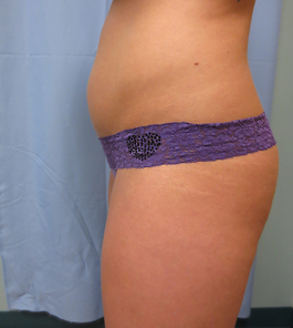 Coolsculpting Before and After | Dr. Thomas Hubbard