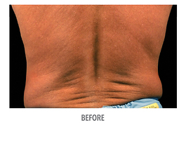 Coolsculpting Before and After | Dr. Thomas Hubbard