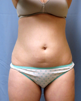 Coolsculpting Before and After | Dr. Thomas Hubbard