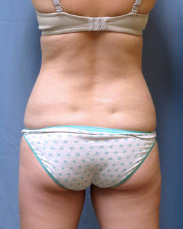 Coolsculpting Before and After | Dr. Thomas Hubbard