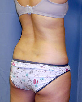 Coolsculpting Before and After | Dr. Thomas Hubbard