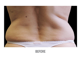 Coolsculpting Before and After | Dr. Thomas Hubbard