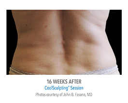 Coolsculpting Before and After | Dr. Thomas Hubbard