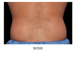 Coolsculpting Before and After | Dr. Thomas Hubbard