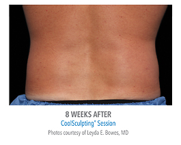 Coolsculpting Before and After | Dr. Thomas Hubbard