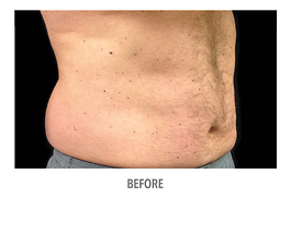 Coolsculpting Before and After | Dr. Thomas Hubbard