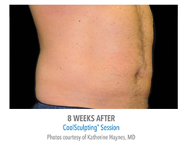 Coolsculpting Before and After | Dr. Thomas Hubbard